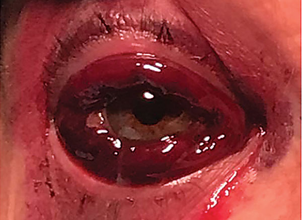 Fig. 2. Extensive protruding subconjunctival hemorrhage.