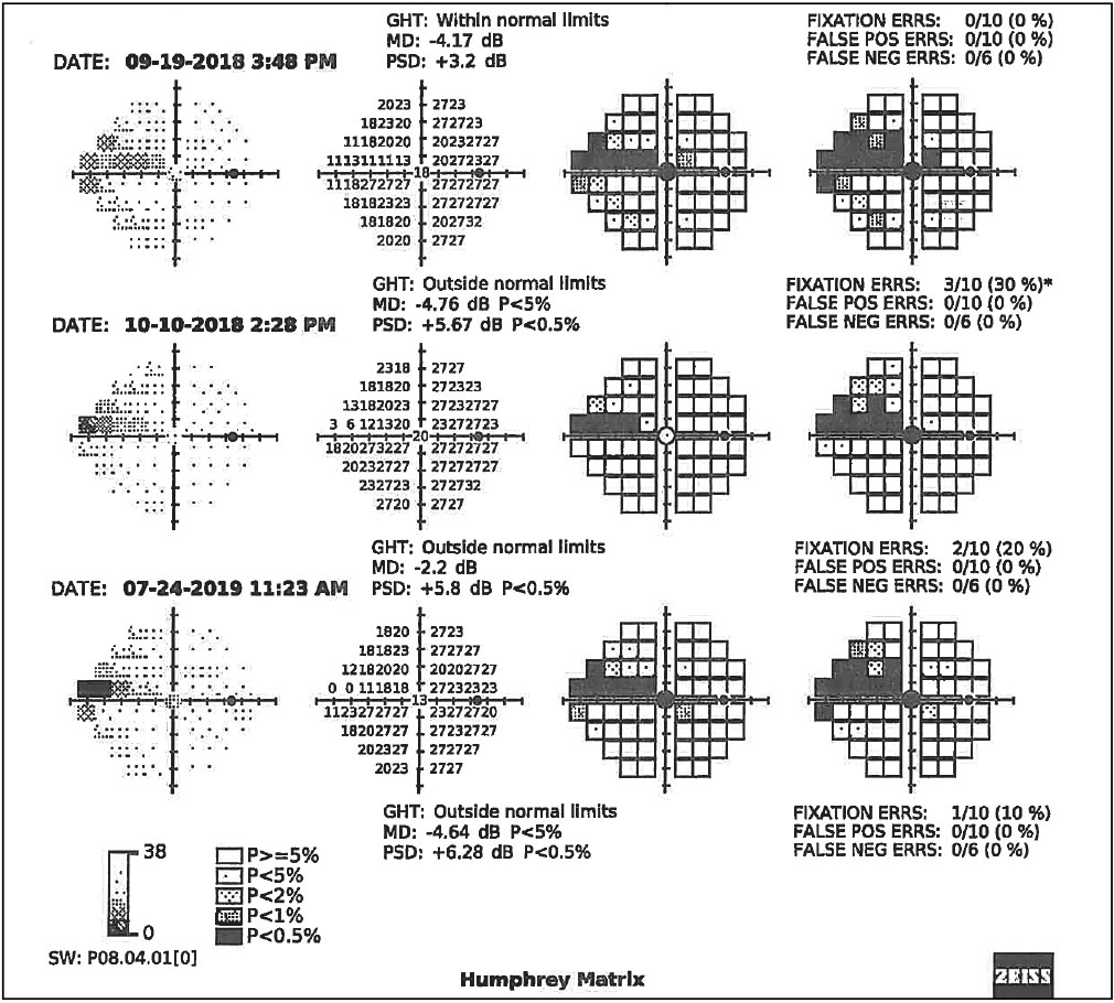 Fig. 4. Serial visual field results using Zeiss’s frequency doubling technology on the right eye of the patient in Figs. 2 and 3, confirming functional VF defects in the form of a nasal step progressing to a superior arcuate scotoma. 