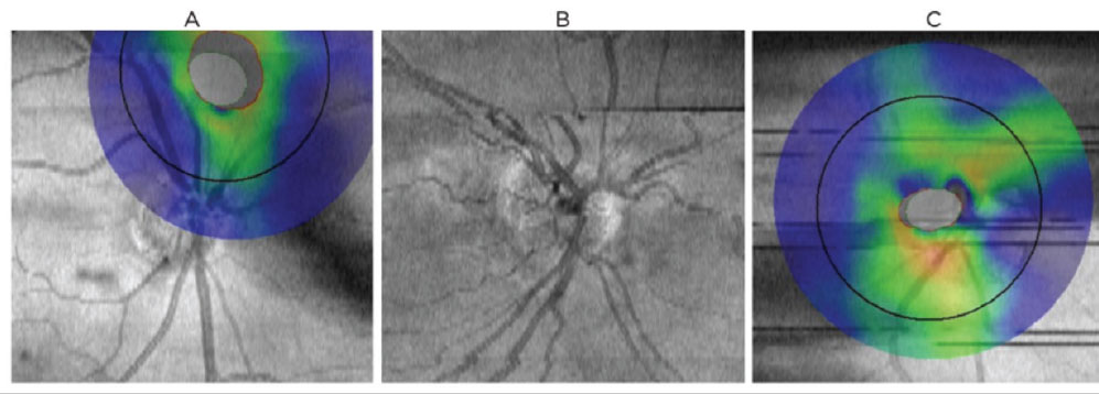 Fig. 6. Common scan artifacts and confounders to OCT interpretation on the Optovue RTVue-100. (A) Centration artifact: poor target alignment of analyzed structures results in a false increase/decrease of tissue thickness. (B) Motion artifact, <i>e.g.</i>,  as results from head movement, saccades or breathing. Appears as misalignment of blood vessels and can lead to segmentation error. (C) Blink artifact: appears as horizontal gaps in data. 