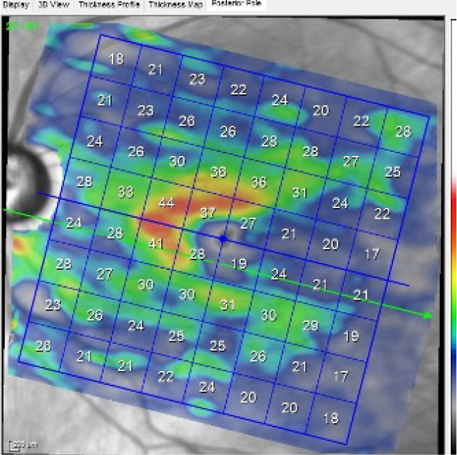 A macular scan of the left eye, specifically isolating the ganglion cell layer. A normal ganglion cell layer falls within the 40µm range.