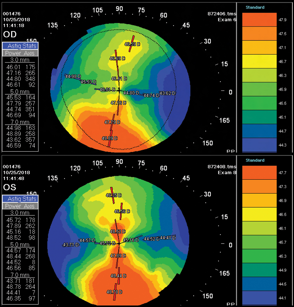 Fig. 3. Distorted corneal topography because of temporary corneal warpage from a high-riding GP contact lens.