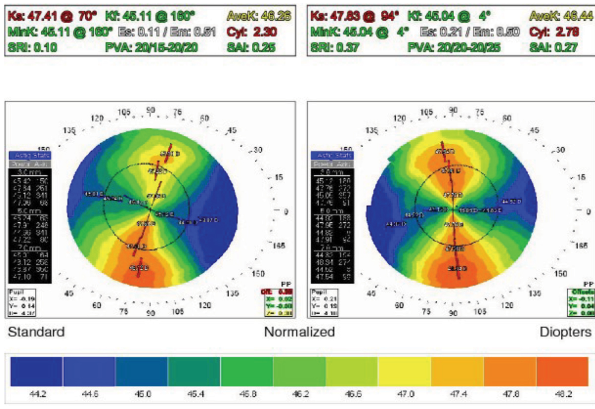 Fig. 4. The topography one week after cessation of CL wear.