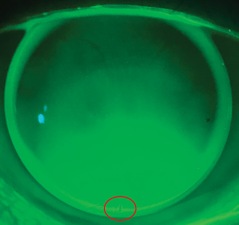 Fig. 6. This front toric GP shows no rotation with the marking located at 6:00.