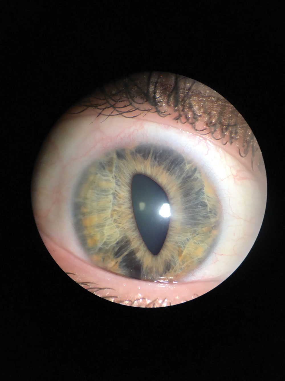 Colored lenses can appeal to both the fashion-consicious and those with iris abnormalities looking for aesthetic improvement, as in this case of iridocorneal endothelial syndrome before (top) and after (middle) application of an iris-print lens.