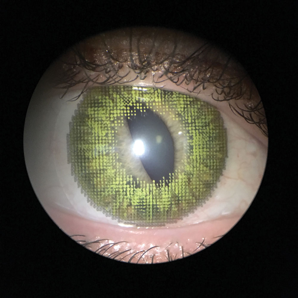 Colored lenses can appeal to both the fashion-consicious and those with iris abnormalities looking for aesthetic improvement, as in this case of iridocorneal endothelial syndrome before (top) and after (middle) application of an iris-print lens.