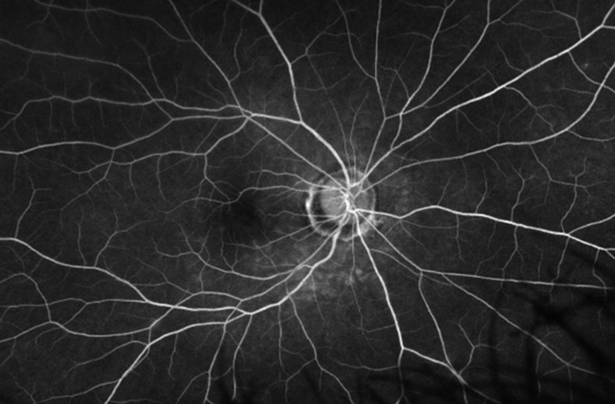 Fig. 4. Late frame of the FA of the right eye.