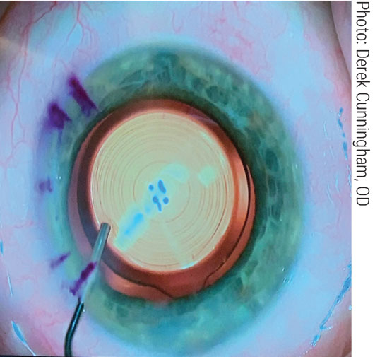 The Synergy aims to give patients a wider range of vision by combining two optical concepts.