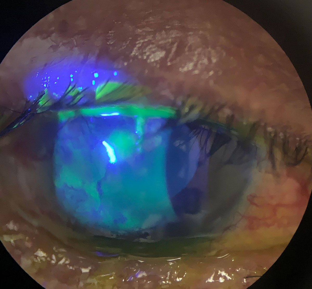 Antibiotics in the bowl of a scleral could help heal persistent epithelial defects and neurotrophic keratitis, as seen in this eye.