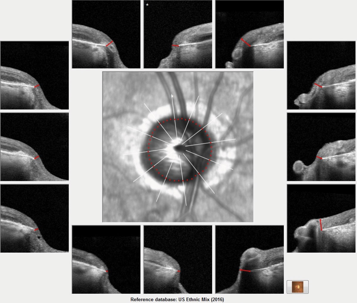 Measuring minimum rim width and peripapillary retinal nerve fiber layer thickness could help you distinguish whether the patient has glaucoma or compressive optic neuropathy. Photo: James Fanelli, OD.