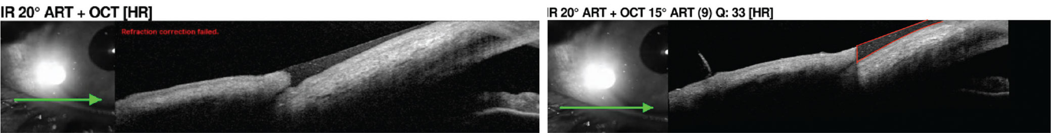 Tear meniscus measurement using the anterior segment lens on OCT. The tear meniscus is outlined in red in the right image, which can be further evaluated for quality.