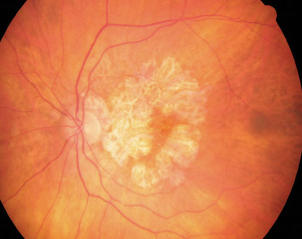 More precise tracking of geographic atrophy’s development can yield clues to its clinical course. Image courtesy of  Wendy Harrison, OD, PhD.