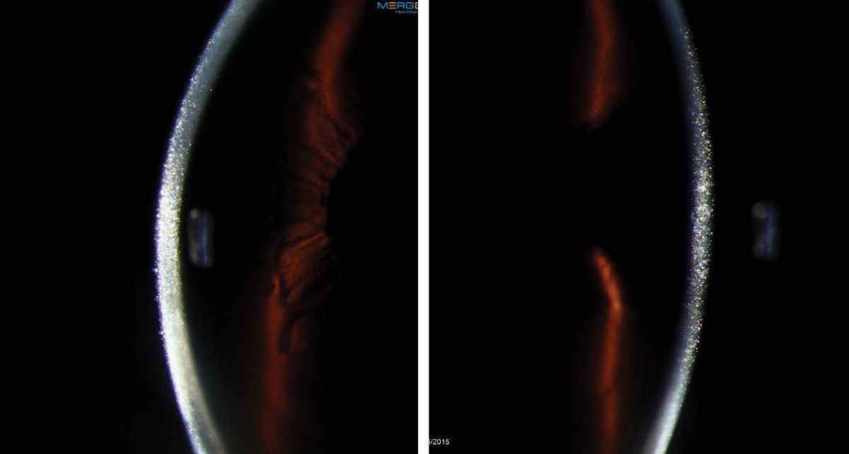 Biomicroscopy revealed dense, bilateral, iridescent and polychromatic deposits within the full thickness of the corneal optic section.