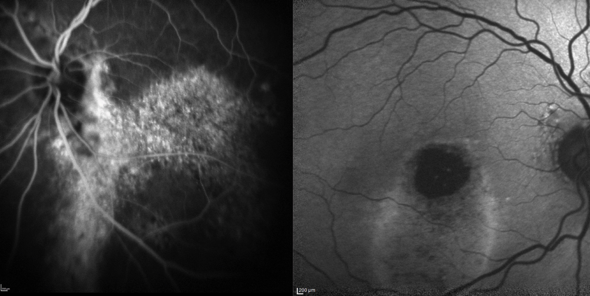 Fig. 9. Chronic serous detachment from CSC leading to RPE disruption shown by FA (left) and FAF (right) in two different patients. FAF is very useful with CSC patients and can shed some light on the condition’s chronicity with the discovery of gravitational tracts due to shifting subretinal fluid.