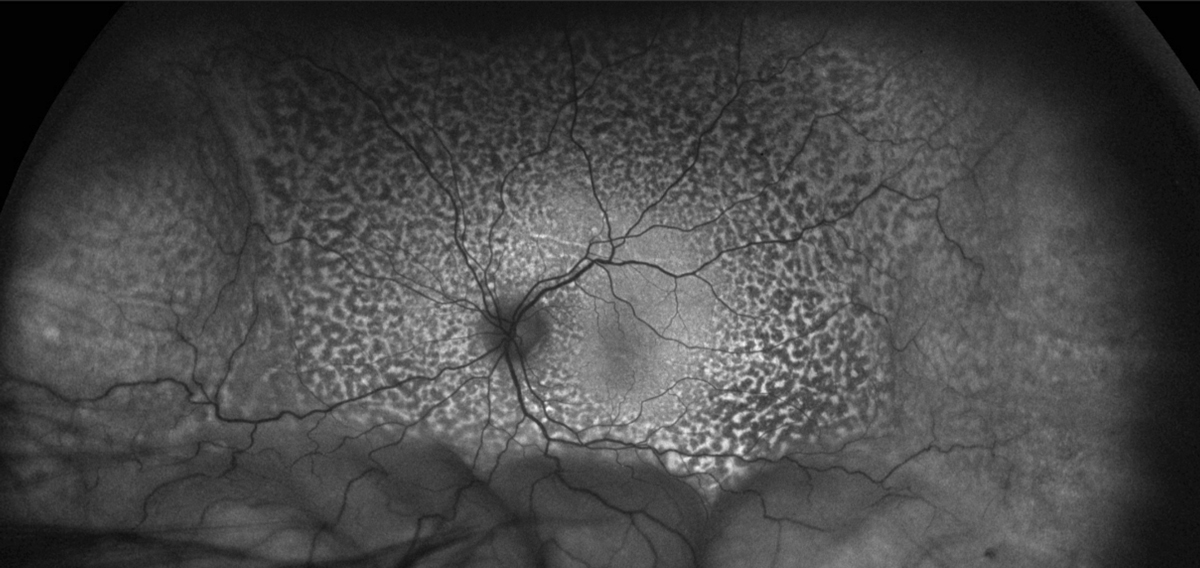 Fig. 16. Widefield FAF shows extensive pigmentary alteration of the left eye.