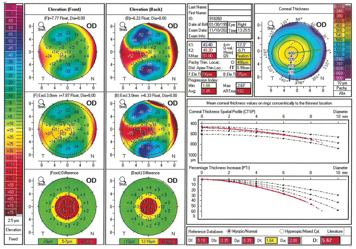 Though scleral lenses can temporarily flatten corneas, it only takes one overnight for changes to revert to baseline. Photo: Mitch Ibach, OD.