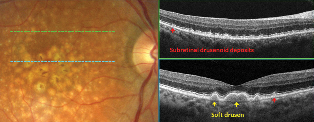 Fig. 3. OCT subclassification of drusen in AMD.