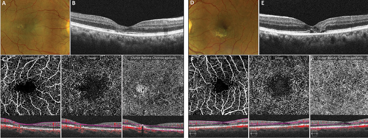 Fig. 5. OCT-A abnormalities in early MacTel2.