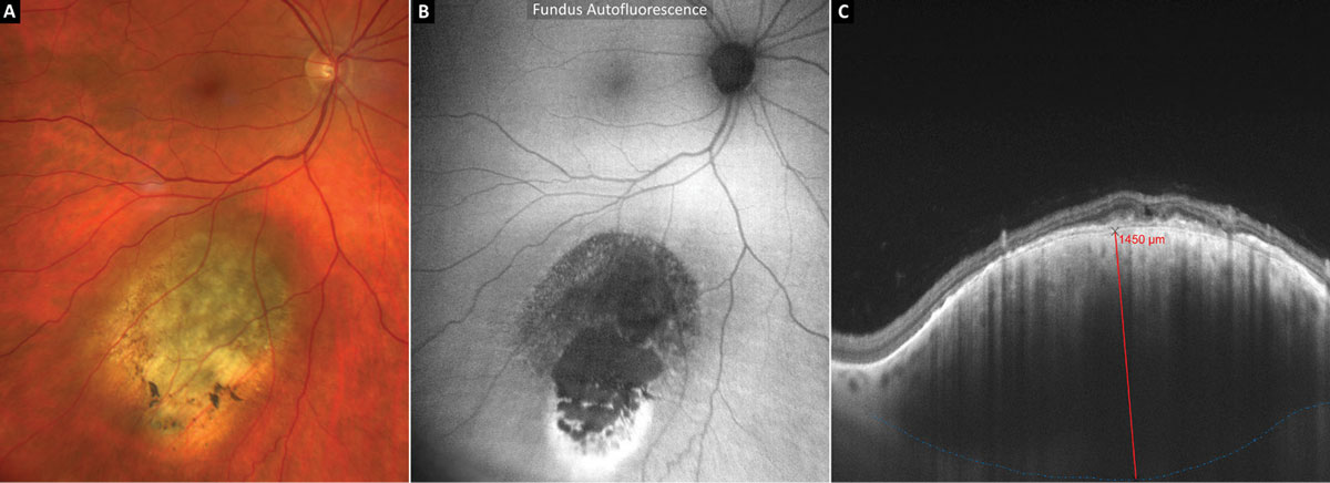 Fig. 6. EDI-OCT and thickness measurement of a suspicious pigmented choroidal tumor.