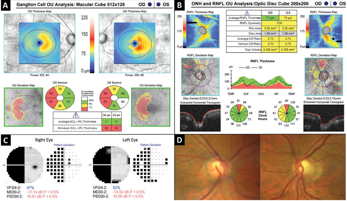 Fig. 7. Hemi-macular GCIPL thinning as a result of retrochiasmal visual pathway damage.