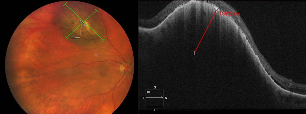 fSRT may effectively treat small, medium and large tumors, this study concluded. Photo: Amy Bade, OD. 