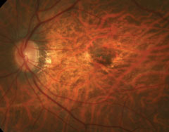 Despite its effectiveness in neovascular AMD, anti-VEGF struggles to reduce CNV in high myopes. Image courtesy of  Mark Dunbar, OD. 