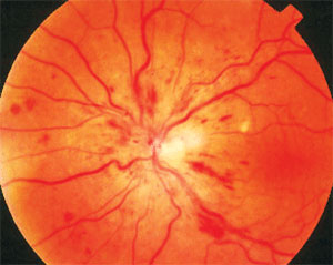 The group of patients receiving ranibizumab injections fared better in many areas than those receiving sham injections.