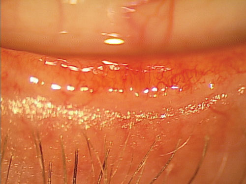 Videokeratography could be an effective alternative to interferometers for assessing the lipid layer. Photo: Mile Brujic, OD.