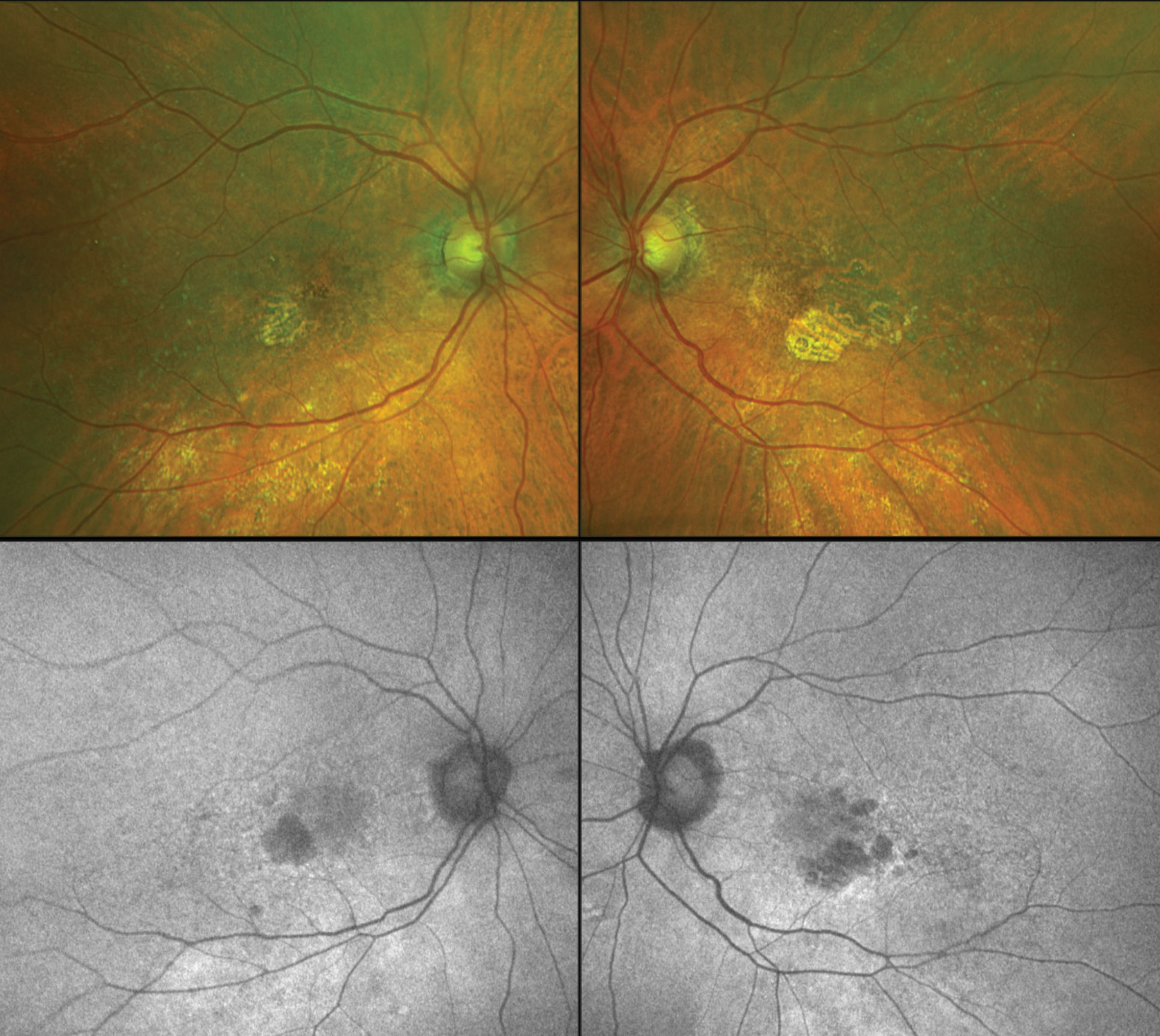 Patients with higher CVI (i.e. greater preservation of the vascular component) have a lower expansion of GA lesion. 