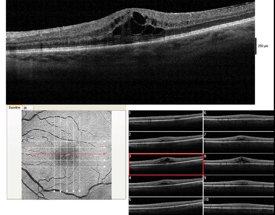 Treating patients post-cataract surgery with NSAID eye drops, not combined with anything else, may promote an anti-inflammatory response. 