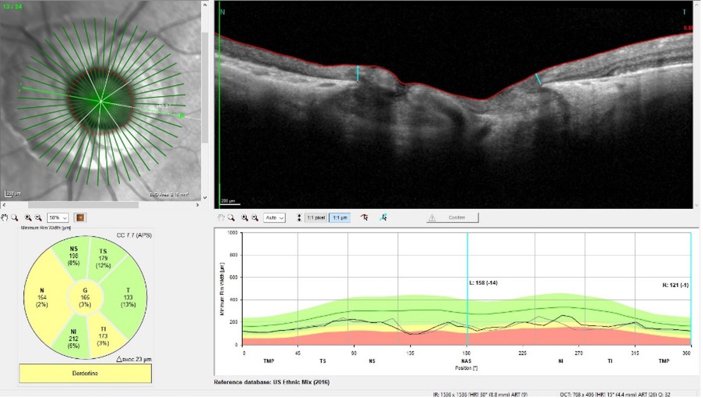 Note that the circumpapillary RNFL area is affected by the peripapillary atrophy, whereas the neuroretinal rim, showing significant glaucomatous damage, is relatively stable.