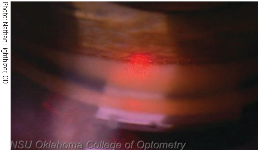 To date, six states allow optometrists to use SLT to lower intraocular pressure in glaucoma patients (Oklahoma, Kentucky, Louisiana, Alaska, Arkansas and Wyoming).