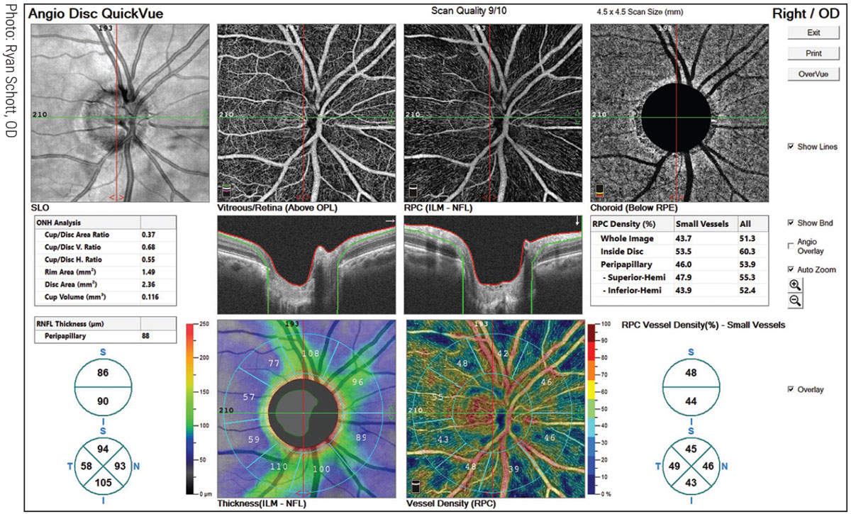 It was only this past summer that all 50 states achieved autonomy in glaucoma care, when a Texas law freed ODs there from having to comanage all aspects with an MD. Above: an AngioVue OCT-A scan identifies capillary dropout that corresponds to RNFL dropout.