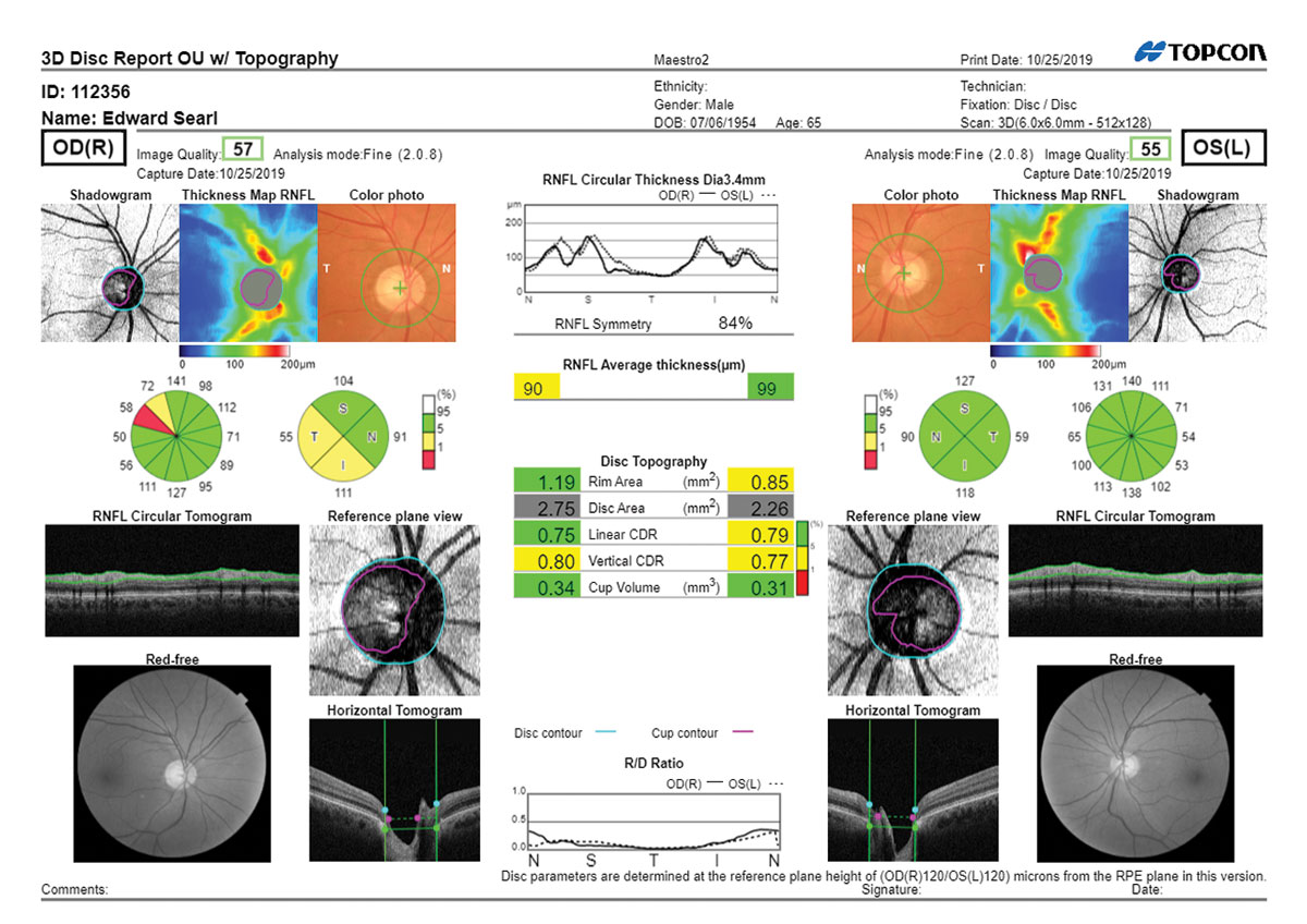 Investing in the right equipment, such as OCT, is essential to success when adding glaucoma to your practice.