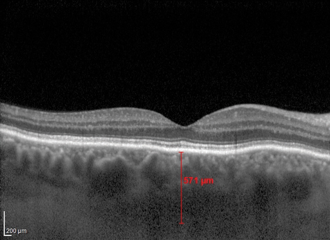 Patients with hyperopia tend to have thicker choroids, researchers found. Photo: Jim Williamson, OD, and Meagan Williams, OD.