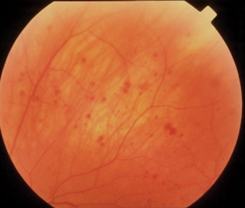 This study found that almost a quarter of newborns have a retinal hemorrhage. Photo: Leticia Rousso, OD, and Joseph Sowka, OD.