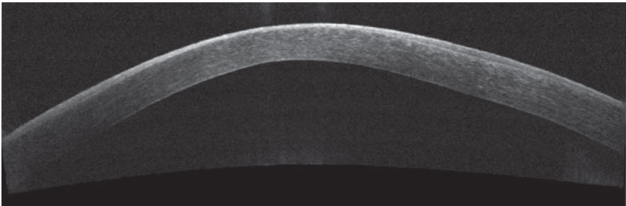 Early intervention for keratoconus patients is crucial to optimize outcomes. Photo: Katelyn Lucas, OD.