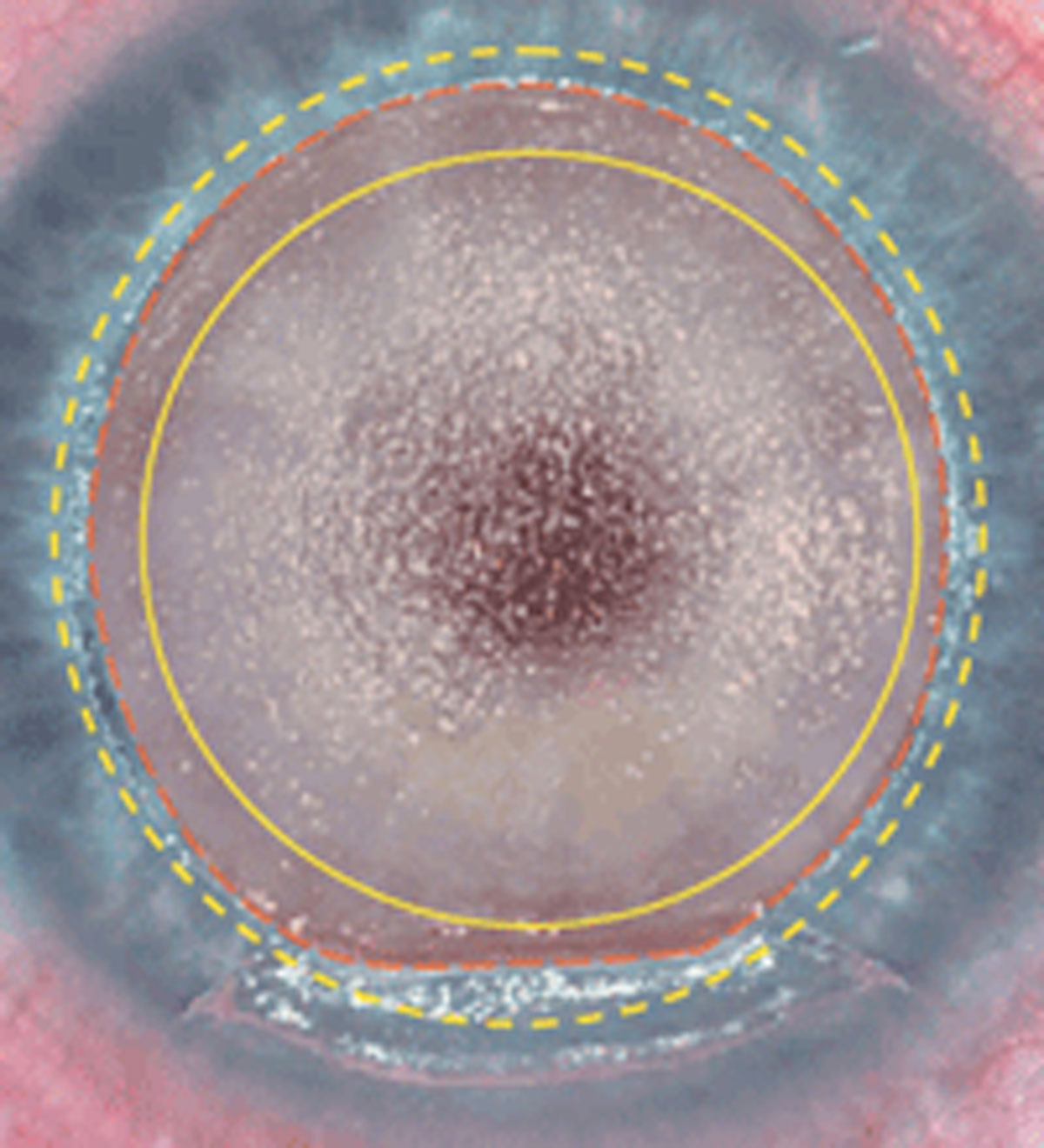 Wavefront-guided LASIK outperformed SMILE in this study. Photo: Martin L. Fox, MD. 