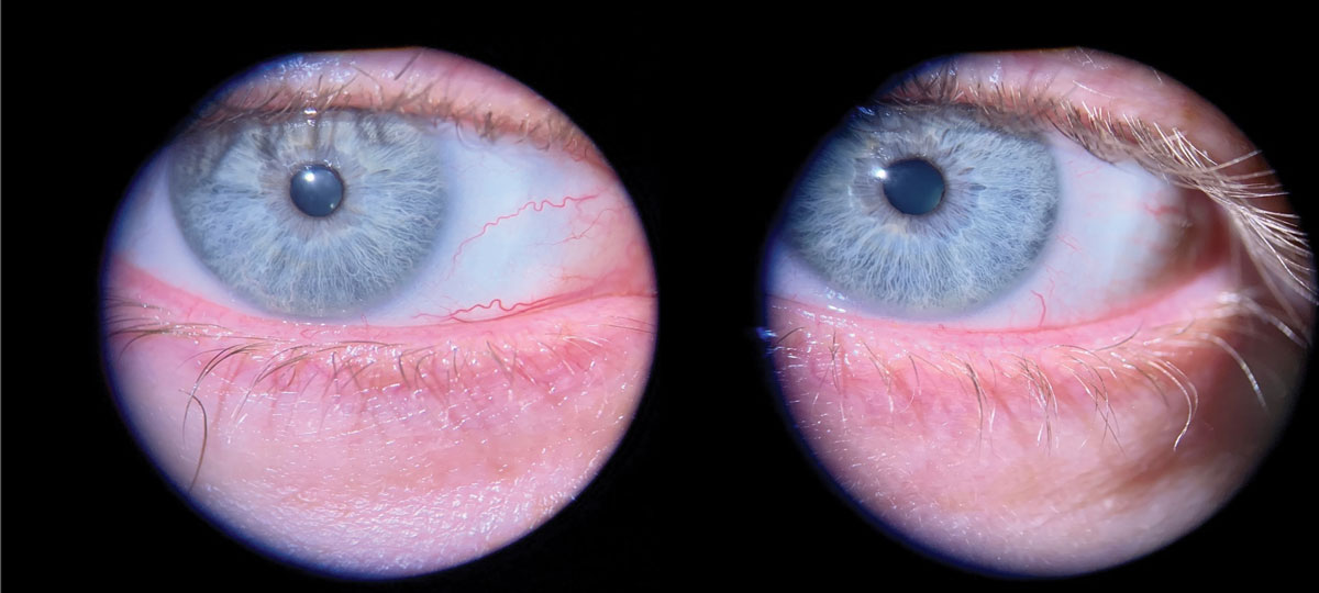 Fig. 2. Seborrheic blepharitis is visible as the oily-yellow film that has accumulated between the lashes on the lower and upper lids.