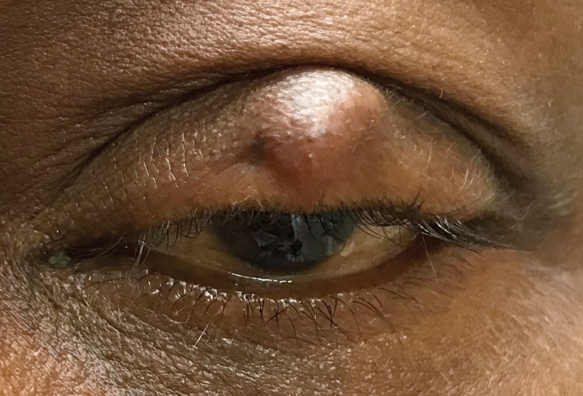 Antibiotics were not shown to improve chalazion in this study. Photo: Joseph W. Sowka, OD.