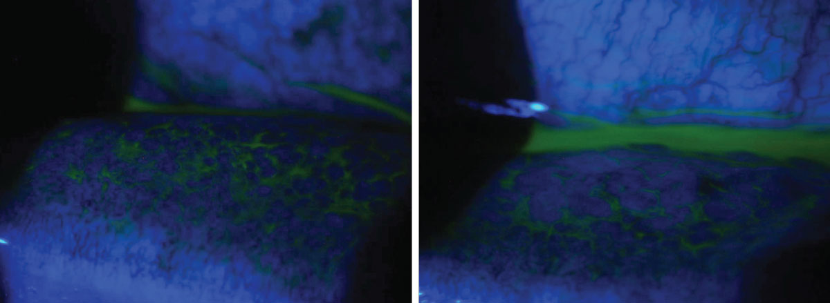 A 58-year-old male presented with complaints of irritation in the left eye. He saw another provider the day prior and was given moxifloxacin. He started using the drops but felt this made his symptoms worse, and the pain and redness moved to both eyes. He reported tearing and mild crusting of his lids in the morning. On examination, both eyes revealed 2+ conjunctival injection and a 2+ follicular response. The patient was diagnosed with viral conjunctivitis and educated on the contagious nature and expected duration of the condition. He was instructed to discontinue the topical antibiotic, wash all towels and sheets and use preservative-free artificial tears four times daily in both eyes. Despite the controversy over steroids in viral disease in the absence of corneal involvement, the patient was placed on a sample of Eysuvis (loteprednol etabonate, Kala Pharmaceuticals) four times daily in both eyes due to the degree of discomfort and his ability to take time off work. He was instructed to return in two weeks for follow-up with an IOP check and to call with any worsening of symptoms.