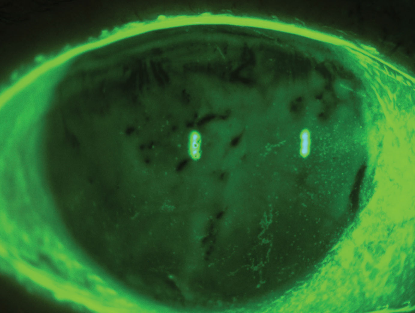 Evaporative dry eye syndrome with reduced TBUT and diffuse superficial punctate keratitis.