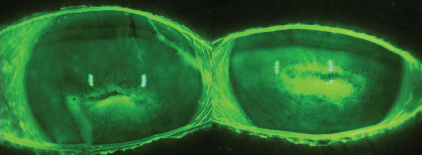 Stage 2 neurotrophic keratitis.