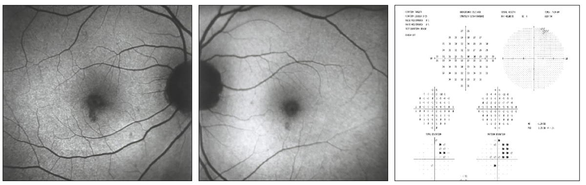 Initial visit FAF area of hypofluorescence (OD, left; OS, middle) indicating loss of RPE and corresponding to paracentral visual field defects 2’ HCQ toxicity (right).