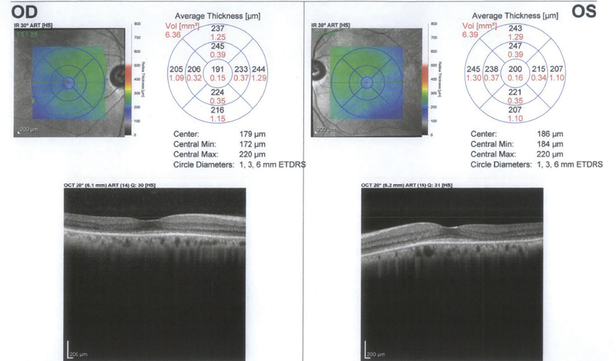 SD-OCT one year after discontinuation of HCQ showing continued loss of the IS-OS junction and outer nuclear layer.