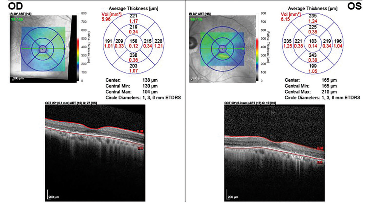 Fve years after discontinuation showing loss of the IS-OS junction, outer nuclear layer and RPE.