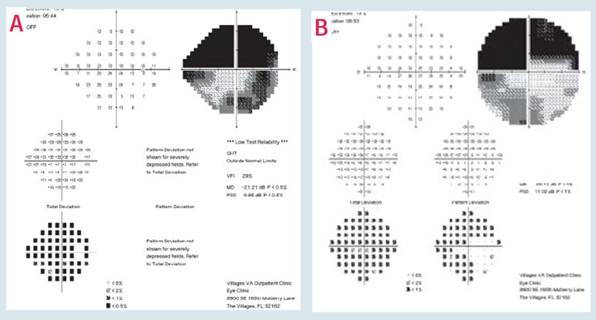 BCVA, beta-peripapillary atrophy area/disc area ratio and antihypertensive drug usage are among the risk factors for glaucomatous central visual field loss, study shows. Photo: Austin Lifferth, OD. Click image to enlarge.