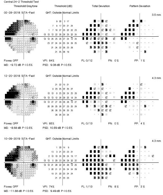 Vessel density parameters can be helpful in predicting visual field progression in OAG eyes.