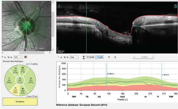 Correctly locating Bruch's membrane opening is crucial in patients with high myopia. Photo: James Fanelli, OD. 