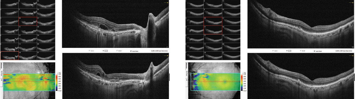 Subretinal fluid is associated with better visual outcomes in nAMD. Photo: Steven Ferrucci, OD, and Jay M. Haynie, OD. 