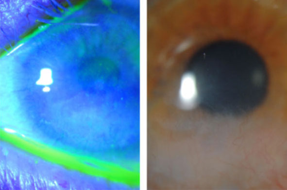 Changes in cell morphology in both the central cornea and limbal areas may signal LSCD. 